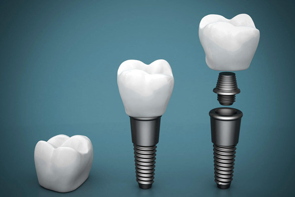 Dental Implant